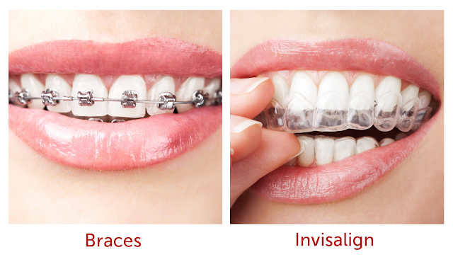 Invisalign vs Metal Brackets