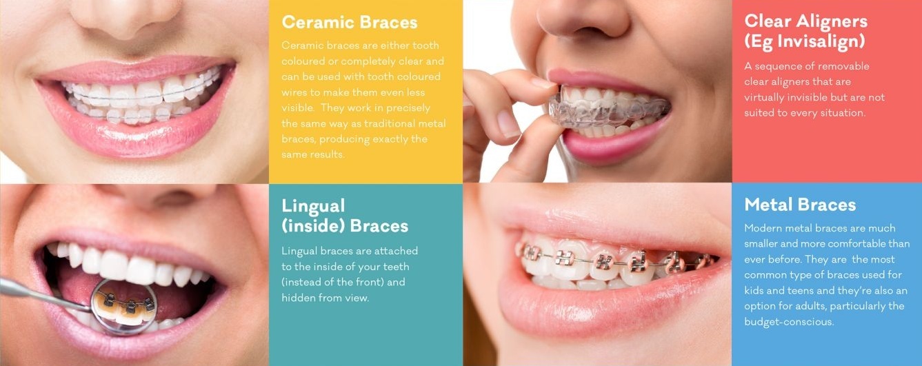 Types Of Braces Available